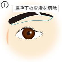 画像：眉毛下皮膚切除の流れ (1)