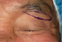 画像：眉毛下皮膚切除（上眼瞼リフト）手術デザイン
