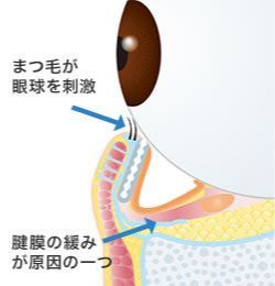 画像：下眼瞼内反手術(2)