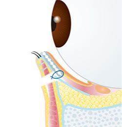 画像：下眼瞼内反手術(3)