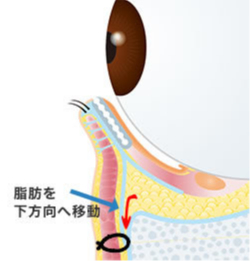 画像：眼窩脂肪移動術 ハムラ法(2)