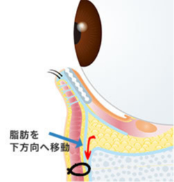 画像:眼窩脂肪移動術 ハムラ法(2)