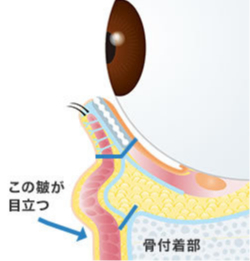 画像:眼窩脂肪移動術 ハムラ法(1)
