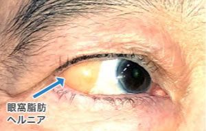 画像：眼窩脂肪が眼球側に突出している症例 手術前