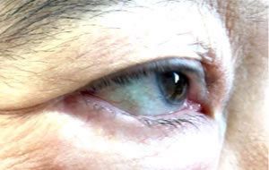 画像：眼窩脂肪が眼球側に突出している症例 手術後