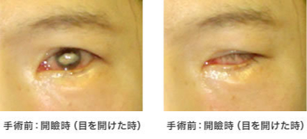 画像：症例 顔面神経麻痺による眼症状に対する手術(1)