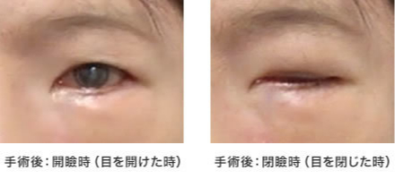 画像：症例 顔面神経麻痺による眼症状に対する手術(2)