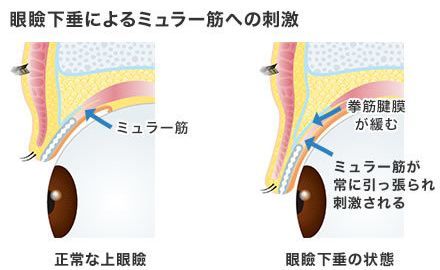 画像：眼瞼下垂によるミュラー筋への刺激
