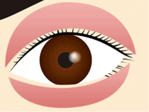 画像:その他の眼形成手術